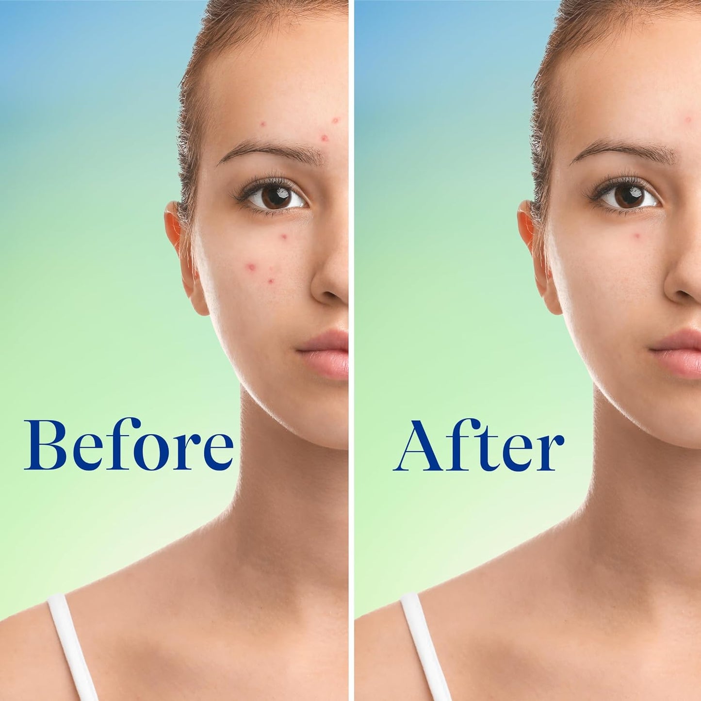 Differin Maximum Strength Acne Foaming Cleanser 10% Penzoyl Peroxide