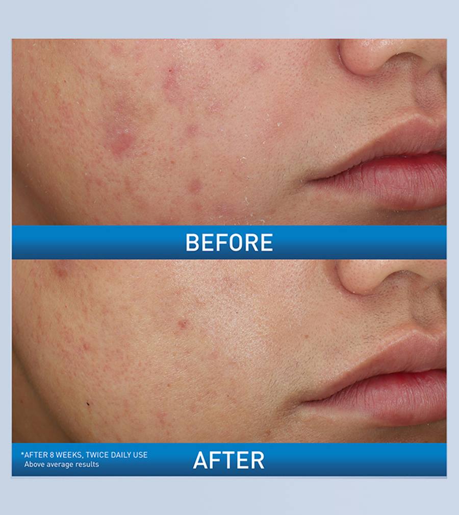 CeraVe Acne Foaming Cream Cleanser 4%