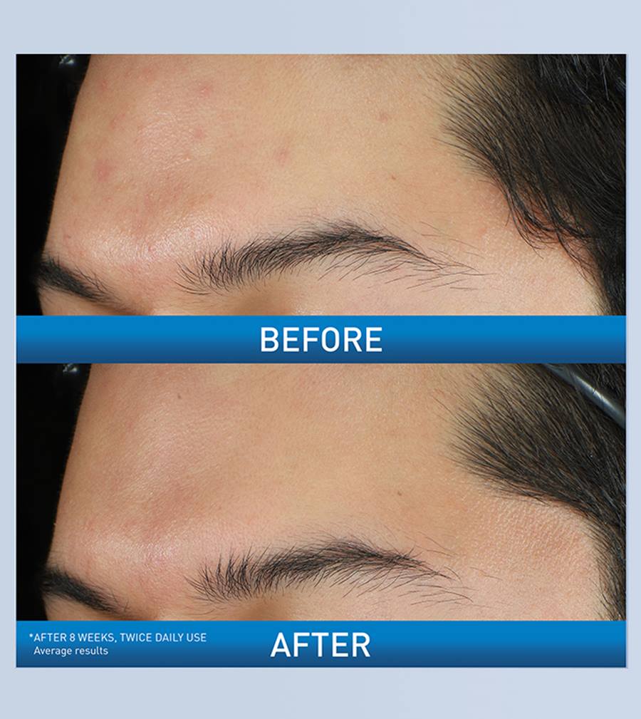 CeraVe Acne Foaming Cream Cleanser 4%