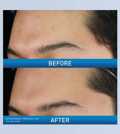 CeraVe Acne Foaming Cream Cleanser 4%