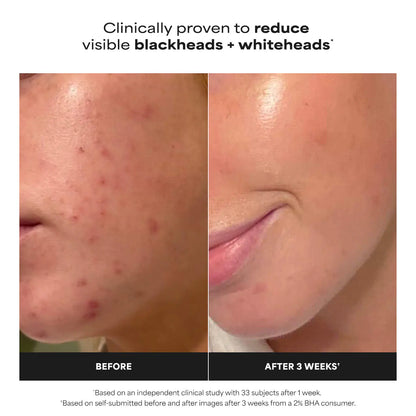 مقشر بولا تشويس السائل 2% BHA Paula's Choice Liquid Exfoliant 30 ml